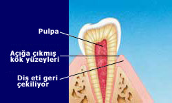 Tooth Sensitivity